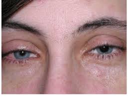Image result for Mydriasis