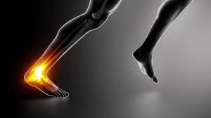 Achilles Tendinopathy Is Treatable With The Proper Approach Achilles Tendinopathy Achilles Achilles Tendonitis