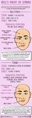 Many studies support the use of corticosteroids and eye care to improve the symptoms of bell's palsy 5 6. Ù…ÙŠÙ… On Twitter Bell S Palsy Vs Stroke