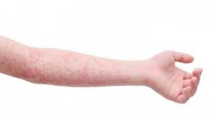 Diabetes mellitus adalah penyakit yang mencegah tubuh kita untuk menggunakan energi yang berasal dari makanan yang kita makan dengan benar. 6 Masalah Kulit Gejala Awal Diabetes Salah Satunya Kulit Gatal Dan Kering Suara Jateng