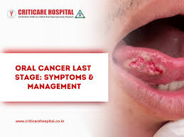 Image result for gum cancer symptoms