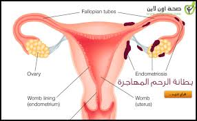 أسباب بطانة الرحم المهاجرة ولماذا تكون بعض النساء أكثر عرضة للإصابة بها من غيرهن