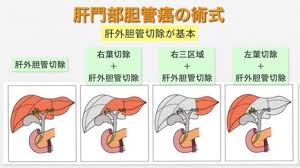 胆道外科 三重大学肝胆膵 移植外科 第１外科