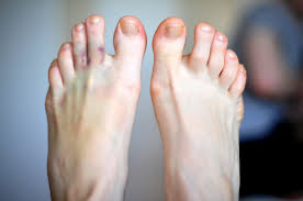 What Are Covid Toes Faawc Blog Delaware Ohio Podiatrist