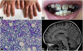 A rare blood cell disorder where there is a sudden decrease in the number of red blood cells (erythrocytes) produced by the. Frontiers Pure Red Cell Aplasia Prca And Cerebellar Hypoplasia As Atypical Features Of Polyglandular Autoimmune Syndrome Type I Aps 1 Two Sisters With The Same Aire Mutation But Different Phenotypes Pediatrics