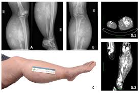 Image result for Chondrosarcoma