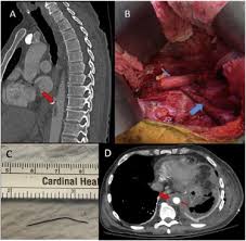 The process of absorbing nutrients or medications into the body by eating or drinking them: Mycotic Aneurysm After Metallic Foreign Body Ingestion Journal Of Vascular Surgery