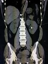 Coronal Multislice Ct Image Reformatted As If The Patient Is Standing In Front Of You There Is A Kidney Sto Diagnostic Imaging Radiology Medical Imaging