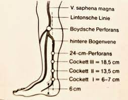 Saphenion Therapie Von Perforanzkrampfadern Mit Venenkleber