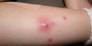 Penyebab bisul di kepala bayi dan cara mengatasinya. 5 Penyebab Bisul Pada Bayi Dan Cara Mengatasinya Merdeka Com