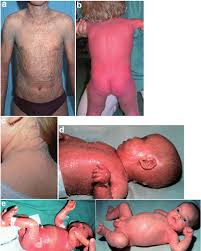 Image result for Ichthyosis