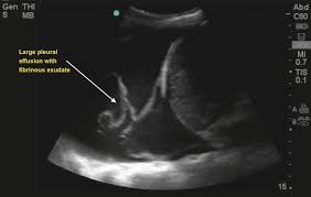 Ultrasound guided assessment of pleural effusion to determine and describe the size and site of the effusion. Lung Monsters Emory School Of Medicine