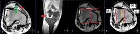 Oth tear of medial meniscus, current injury, r knee, init; Role Of Magnetic Resonance Imaging In The Evaluation Of The Anterior Knee Pain Egyptian Journal Of Radiology And Nuclear Medicine Full Text