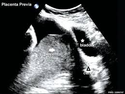 A detailed anomaly scan, in the period of 18 to 22 weeks gestational age, is a great screening tool for a wide variety of congenital anomalies. Placenta Abnormalities Embryology