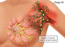As we approach 80, this number drops to 1 in 26. Breast Cancer Signs Symptoms Stages Treatment About Risk Factors Ashray