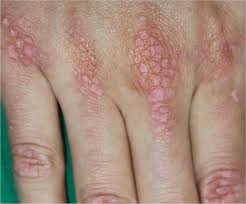 Image result for Dermatomyositis