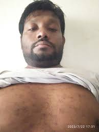 Dr. Vishnu B Patel (Heta Skin Clinic) in Asarwa,Ahmedabad