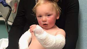 Houston Toddler Recovers After Being Burned With Boiling Water Khou Com