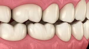 Image result for Occlusal