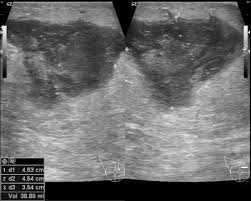 Ibc skin thickening and diffuse tumor areas are more easily visualized by mri & ultrasound than mammograms. Breast Abscess Radiology Reference Article Radiopaedia Org