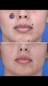 Mole troubles getting you down? 🤕 We’ve got the solution! ✨ Meet our  incredible patient who was born with these moles and after a few procedures  and customized topicals, we successfully removed all 3! ...