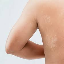 Image result for Skin Infection