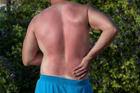 Image result for Sunburn