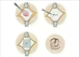 Image result for Hernia Reduction