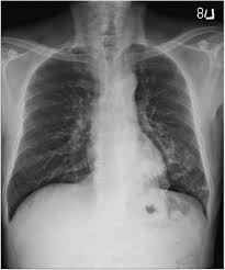Maybe you would like to learn more about one of these? The Impact Of Glycemic Status On Radiological Manifestations Of Pulmonary Tuberculosis In Diabetic Patients