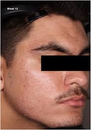 Efficacy and safety of microencapsulated benzoyl peroxide and  microencapsulated tretinoin for the treatment of acne vulgaris: Results  from two phase 3 double-blind, randomized, vehicle-controlled studies