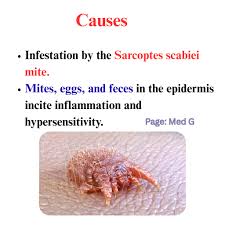 Image result for Sarcoptes scabiei