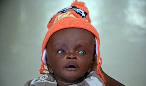 Success! Anthony from Kenya raised $615 to treat congenital hydrocephalus. 