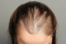 Image result for Alopecia