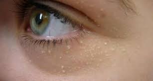 These bumps develop when dead skin cells are trapped in pockets under the skin's surface. White Bumps On Face Small Hard Little Raised White Bumps Not Milia Get Rid Treat White Lumps On Face Not Pimples
