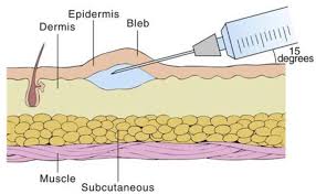 Intradermal Administration