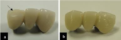 The black rectangle around the rim piece on the. Repair With Glass Ceramic A Incisal Fracture In A Metal Ceramic Download Scientific Diagram