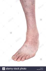 Clubfoot is a birth defect where one or both feet are rotated inward and downward. Clubfoot Assoc Prof Christof Radler Md