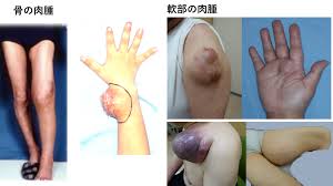 肉腫（サルコーマ） | 希少がんセンター