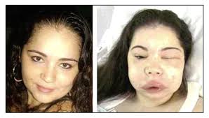 A young woman before (left) and during (right) an episode of facial...