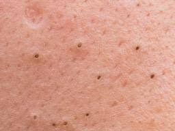 Cara hilangkan blackhead dan whitehead perlu pakai produk apa. Umairaharis On Twitter Haaaa Ni La Blackhead Sebenar Texture Dia Lebih Keras Warna Hitam Nampak Lebih Mengerikan Degil Nak Mampus Susah Nak Hilangkan Bukan Mcm Sebaceous Filaments Blackhead Kalau Picit