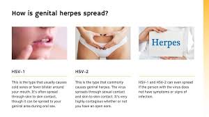 Image result for genital herpes