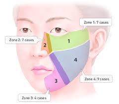 Cheek was born on december 22, 1981 in vantaa, finland as jare henrik tiihonen. Schematic Diagram Four Subdivisions Of The Cheek The Surgical Defect Download Scientific Diagram