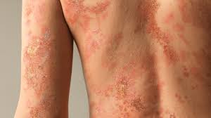 Image result for Pustular Psoriasis