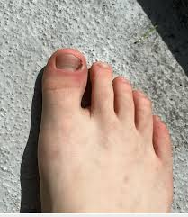 Image result for Onychotillomania feet