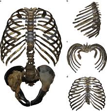The rib cage, shaped in a mild cone shape and more flexible than most bone sets, is made up of varying elements such as the thoracic vertebra, 12 the twelve pairs of ribs, which are embedded within the walls of the muscular structures, attach in the posterior to a thoracic vertebra. Rib Cage Anatomy In Homo Erectus Suggests A Recent Evolutionary Origin Of Modern Human Body Shape Nature Ecology Evolution