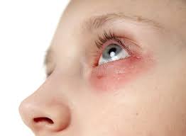 Allergische Reaktion Hautausschlag Engmaschiges Gesichtsbild Eines Madchens Rotung Und Entzundung Der Haut In Den Augen Und Lip Stockbild Bild Von Krank Nahaufnahme 168648591