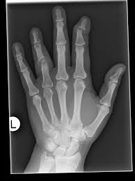Psoriatic Arthritis Radiology Case Radiopaedia Org