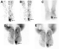 Image result for Osteomyelitis Bone Scan