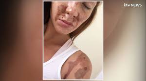 Arthur Collins: Acid attack victim gives emotional account