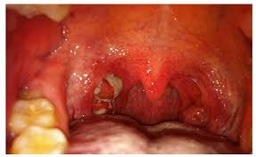 Sindrome De Pfapa Febre Periodica Estomatite Aftosa Faringite